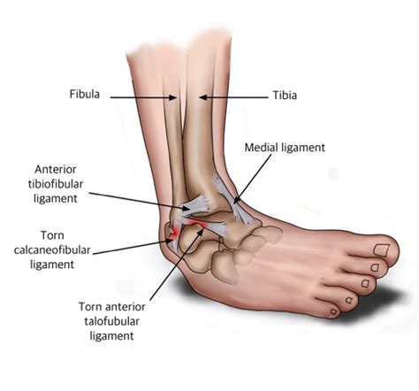 ankle lateral ligament tear test|lateral ligament ankle injury.